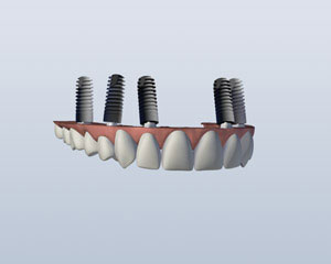 Implant Retained Dentures implant-retained-upper-denture