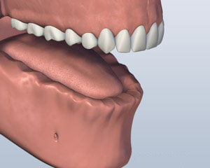 Implant Retained Dentures lower-jaw-all-teeth-missing-before-ball-attachment-denture
