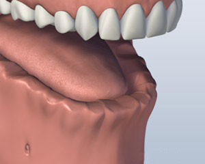 Implant Retained Dentures lower-jaw-all-teeth-missing-before-bar-attachment-denture