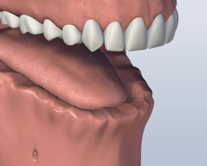Implant Retained Dentures lower-jaw-all-teeth-missing-before-screw-attachment-denture
