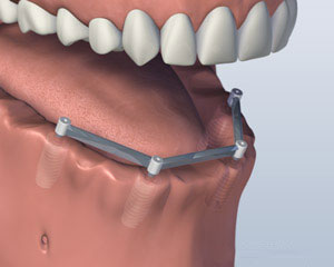 Implant Retained Dentures lower-jaw-all-teeth-missing-with-four-implants-for-bar-attachment-denture