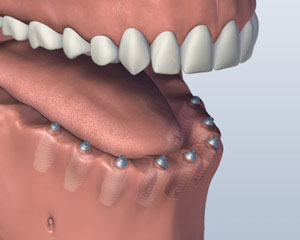 Implant Retained Dentures lower-jaw-all-teeth-missing-with-six-implants-for-screw-attachment-denture