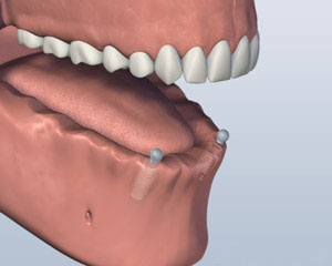 Implant Retained Dentures lower-jaw-all-teeth-missing-with-two-implants-for-ball-attachment-denture