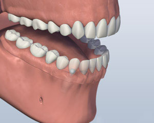 Implant Retained Dentures mouth-with-ball-attachment-denture-latched-onto-lower-jaw-by-two-implants