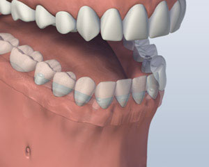 Implant Retained Dentures mouth-with-bar-attachment-denture-secured-onto-lower-jaw-by-four-implants