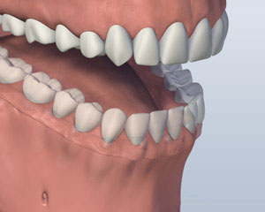 Implant Retained Dentures mouth-with-screw-attachment-denture-affixed-onto-lower-jaw-by-six-implants