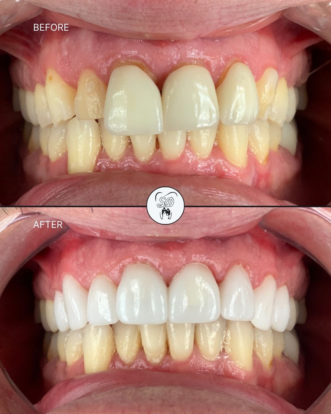 Patient Results Before and After Treatment at Skees Dentistry