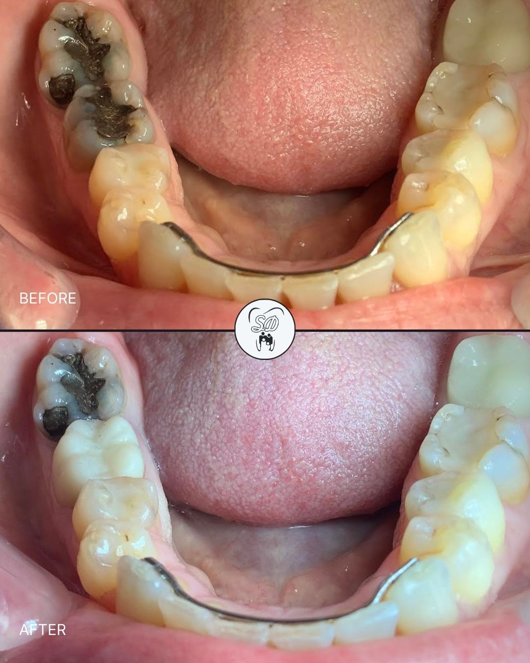 Patient Results Before and After Treatment at Skees Dentistry